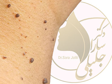 برداشت خال و زوائد کوچک پوستی