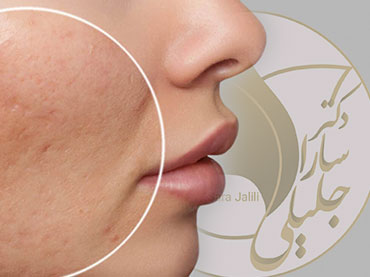 درمان آکنه و اسکار (زخم) آکنه